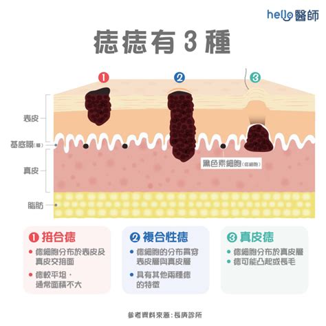 長痣原因|是痣？還是皮膚癌？皮膚科醫師教你揪出「假的痣」，。